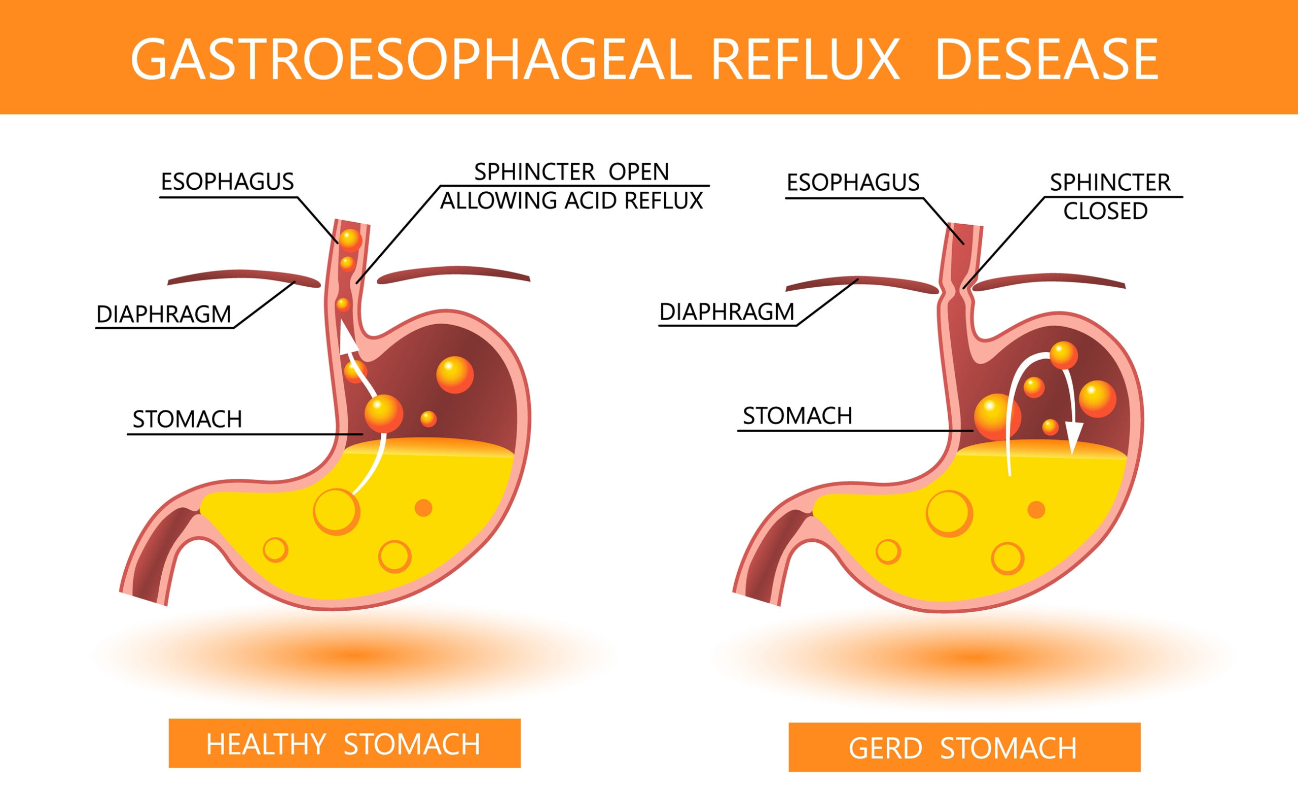 chart comparing healthy to GERD stomach.